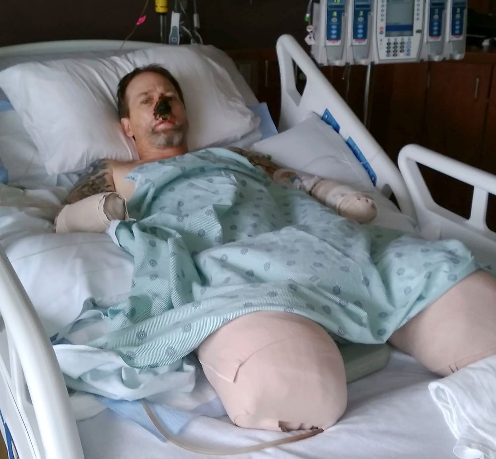 In this Aug. 2, 2018 file photo provided by Dawn Manteufel, Greg Manteufel lays in his hospital bed at Froedtert Hospital in Milwaukee. He lost parts of his arms and legs, as well as the skin of his nose and part of his upper lip from capnocytophaga, a bacteria commonly found in the saliva or cats and dogs which almost never leads to people getting sick, unless the person has a compromised immune system. Manteufel was perfectly healthy when he got sick in June of 2018. Over the last seven years, a team of researchers at Brigham and Women's Hospital in Boston, connected to Harvard Medical School, have tested other healthy people who were affected and developed a theory on why they were affected- a gene change in all the victims. (Dawn Manteufel via AP) In this Aug. 2, 2018 file photo provided by Dawn Manteufel, Greg Manteufel lays in his hospital bed at Froedtert Hospital in Milwaukee. He lost parts of his arms and legs, as well as the skin of his nose and part of his upper lip from capnocytophaga, a bacteria commonly found in the saliva or cats and dogs which almost never leads to people getting sick, unless the person has a compromised immune system. Manteufel was perfectly healthy when he got sick in June of 2018. Over the last seven years, a team of researchers at Brigham and Women's Hospital in Boston, connected to Harvard Medical School, have tested other healthy people who were affected and developed a theory on why they were affected- a gene change in all the victims. (Dawn Manteufel via AP)